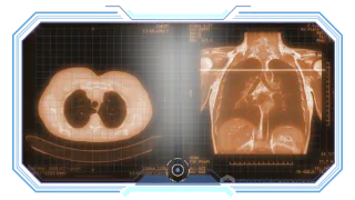 Early Detection of Lung Cancer
