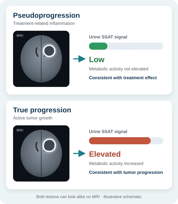 Diagram comparing glioblastoma MRI scans with urine SSAT biomarker levels: low SSAT signal indicates treatment pseudoprogression, while elevated SSAT signal indicates true tumor progression.